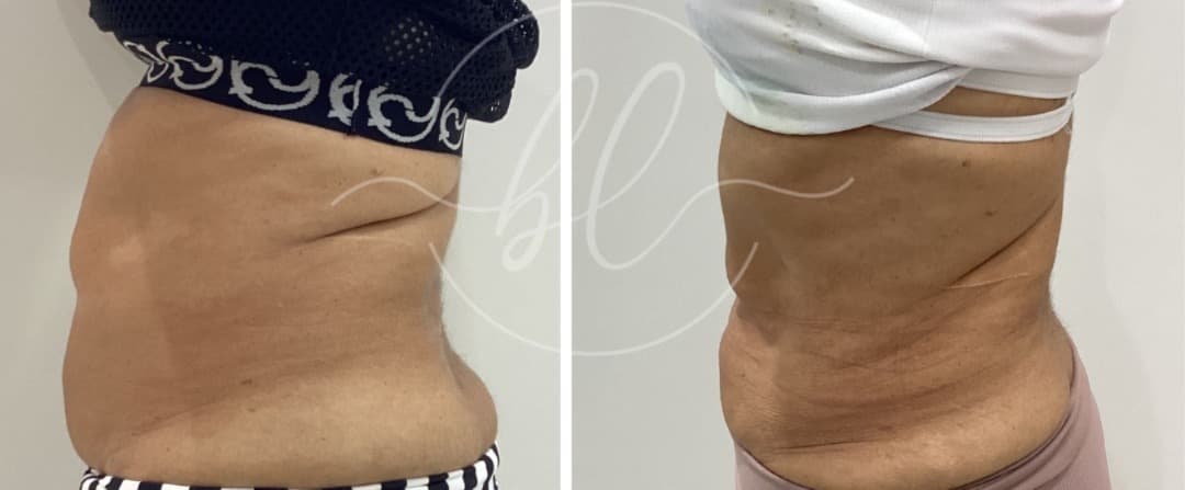Abdômen de uma cliente antes e depois da lipo enzimática, lado a lado