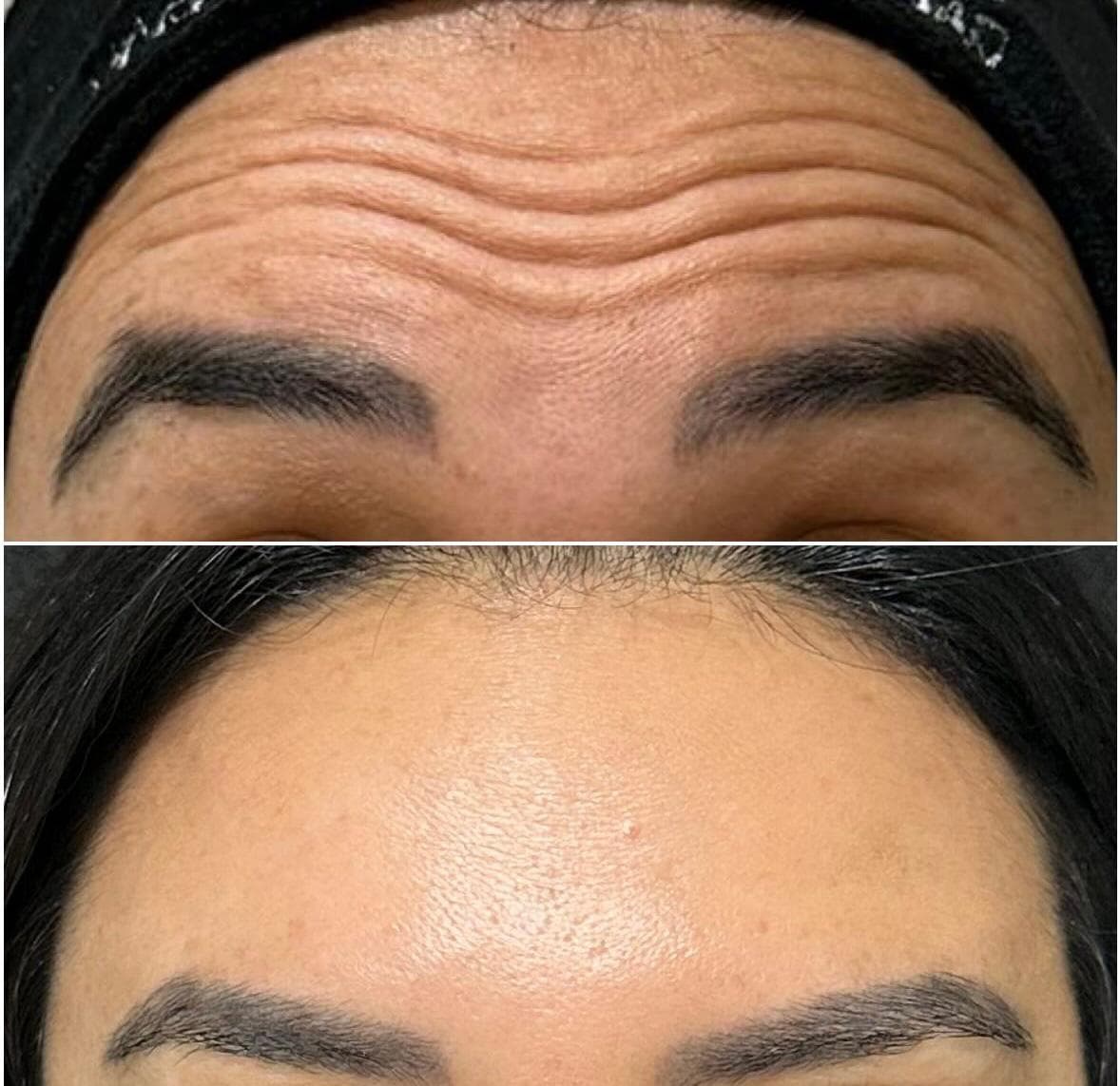 Testa de uma cliente antes, acima, e depois da toxina botulínica, abaixo