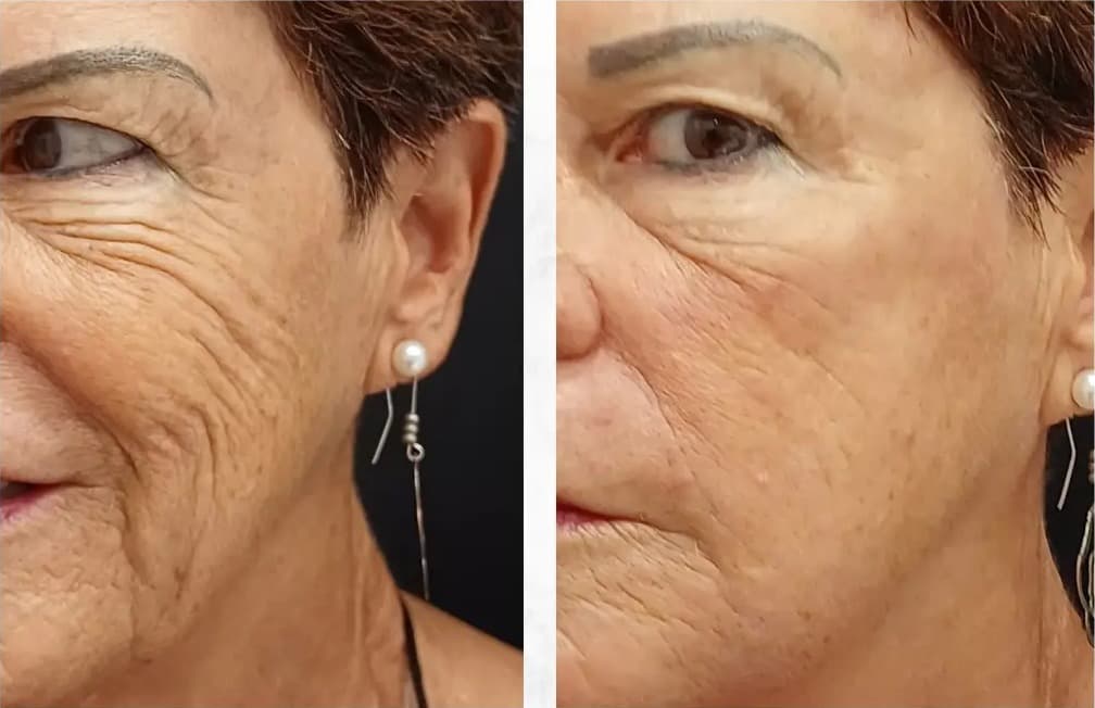 Rosto de uma cliente da rede antes e depois do skinbooster, lado a lado