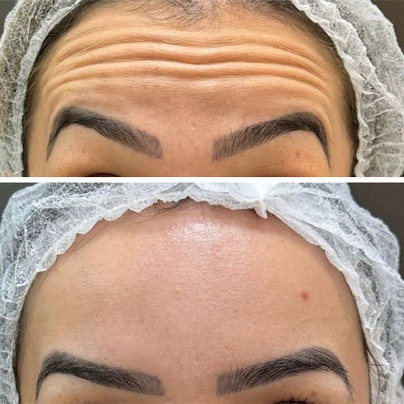 Testa de uma cliente da rede, antes acima e depois abaixo